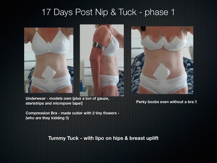 17 Days Post Plastic Surgery 17 Days Post Plastic Surgery